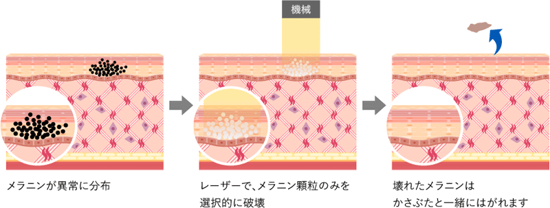 レーザーによる美顔治療