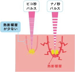 ナノ秒とピコレーザーの違い