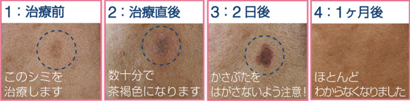 ピコスポット