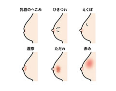 乳房の症状