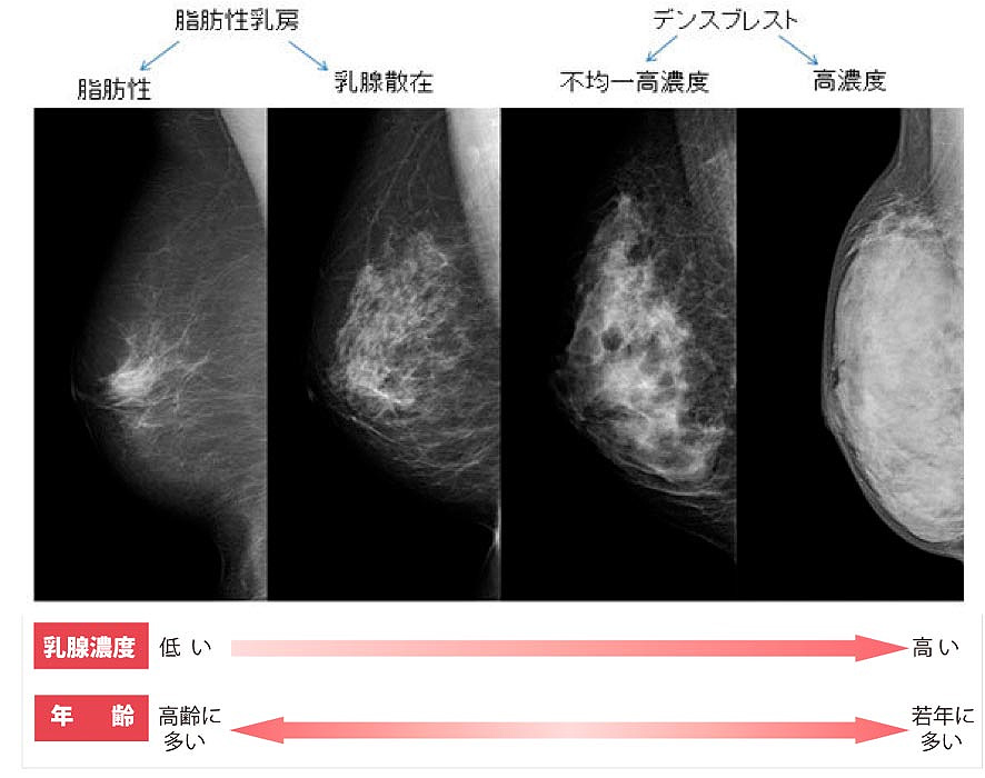 デンスブレスト（高濃度乳房）