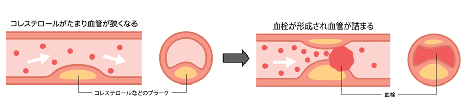 脂質異常症