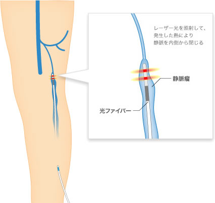 光ファイバー