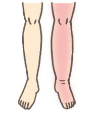 足が赤く腫れて熱感と痛みを伴う。血管が浮き出ることもある