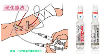 硬化療法で使用する硬化剤(販売元ゼリア新薬社)