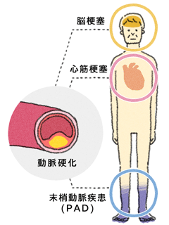 足の血行障害がある方は脳梗塞や心筋梗塞にもなりやすい。