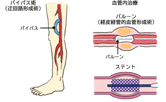 バイパス術（迂回路形成術）・血管内治療